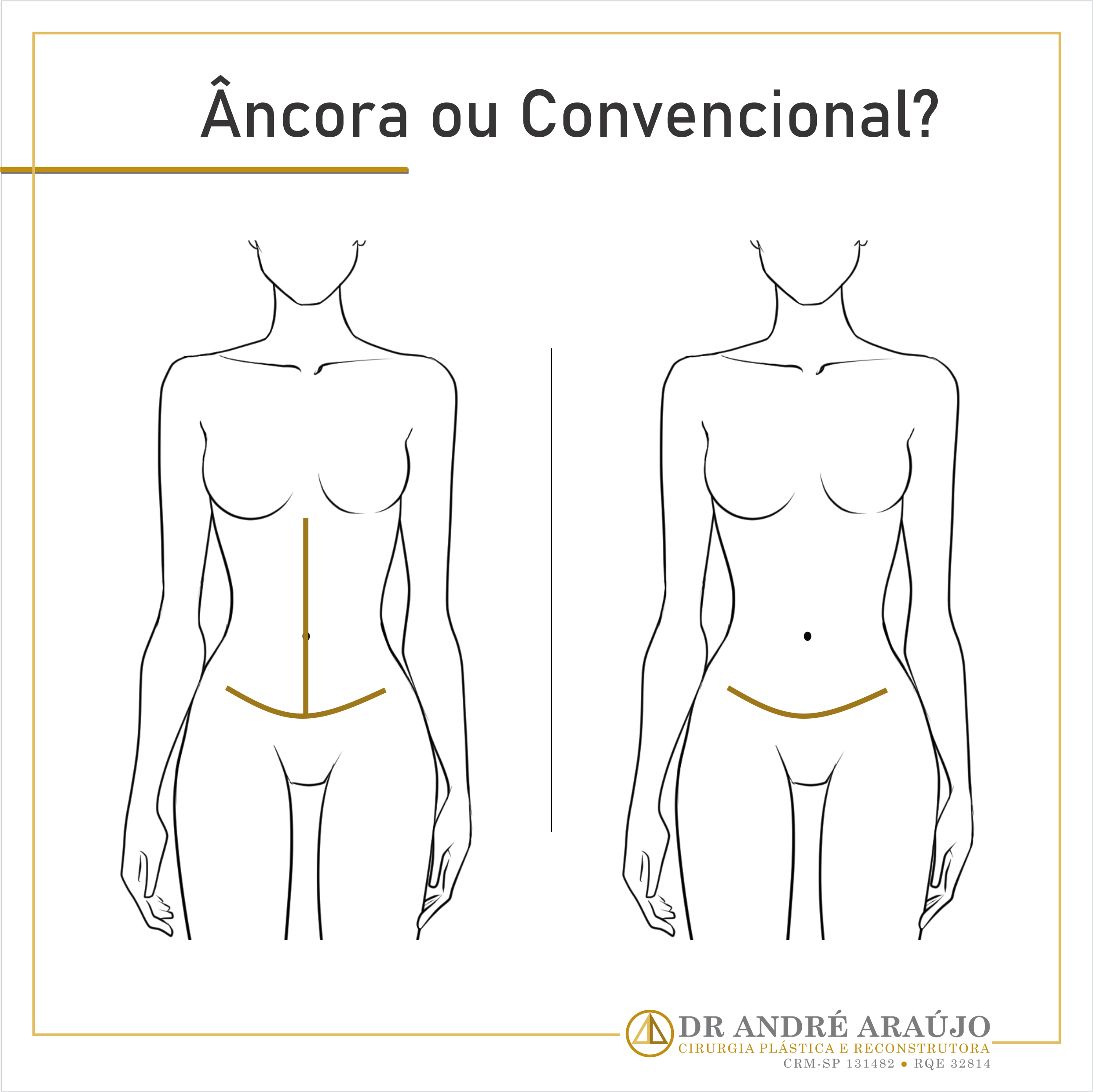 Diferença entre abdominoplastia em âncora ou convencional