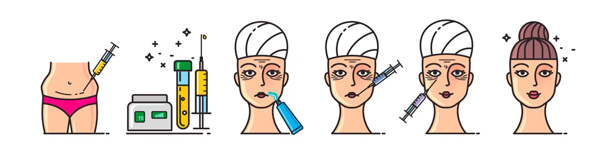 Ilustração do passo a passo do procedimento de enxerto de gordura no rosto