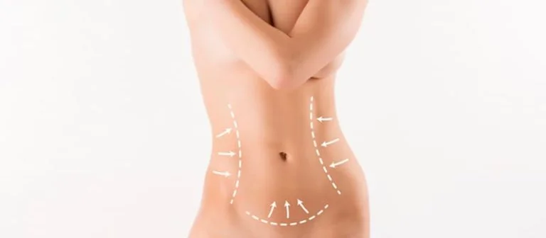 Modelo mostrando os resultados da abdominoplastia pós bariátrica