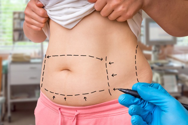 mulher fazendo avaliação para abdominoplastia pós-bariátrica