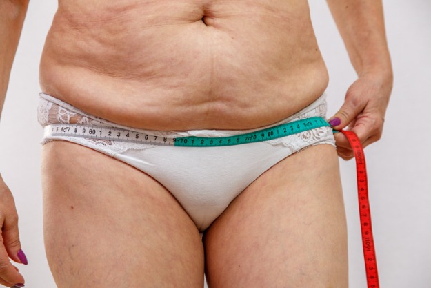 mulher com excesso de pele pronta para cirurgia plástica pós-bariátrica