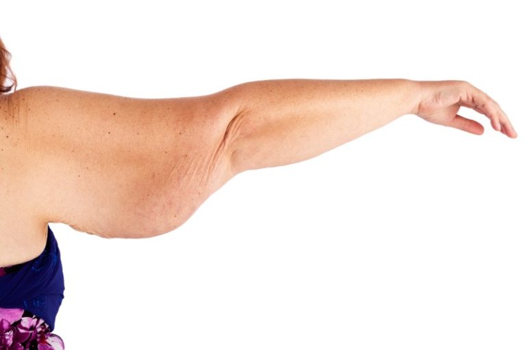 Paciente indicada para realizar a cirurgia lifting de braço