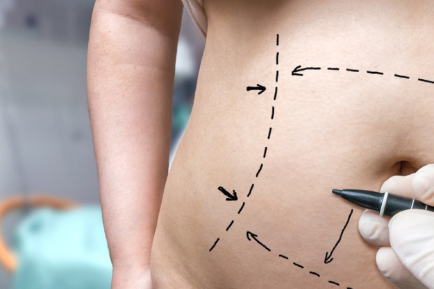 mulher fazendo demarcação de cirurgias plásticas pós-bariátrica