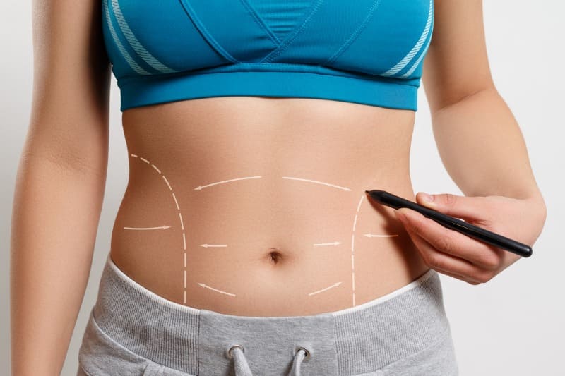 como funciona a abdominoplastia