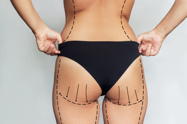 mulher antes do procedimento de gluteoplastia