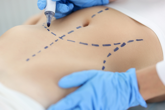 mulher realizando abdominoplastia