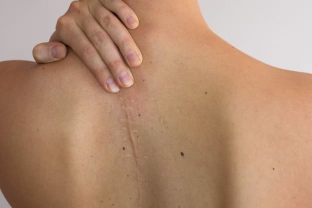 como cuidar da cicatriz pos cirurgia