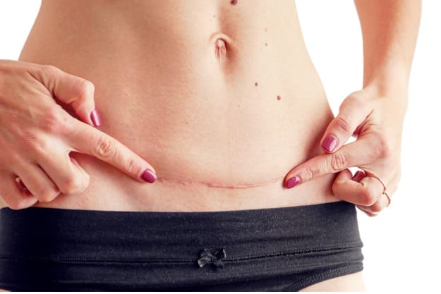 importância incisão correta da abdominoplastia