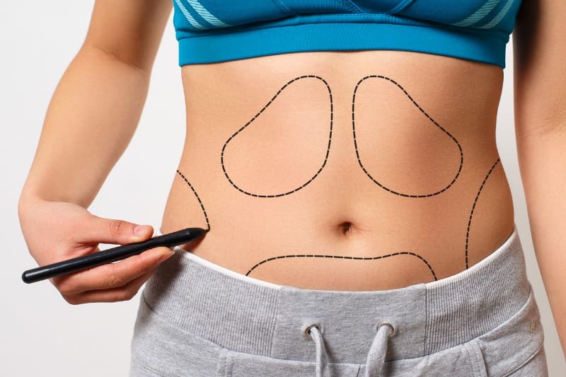 Lipedema na Barriga: Como tratar a gordura abdominal
