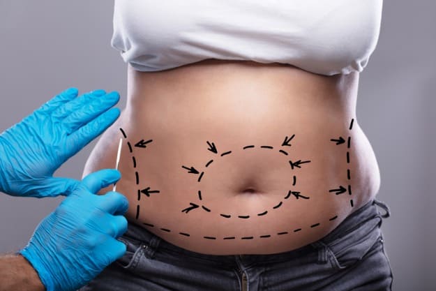 abdominoplastia pós-bariátrica