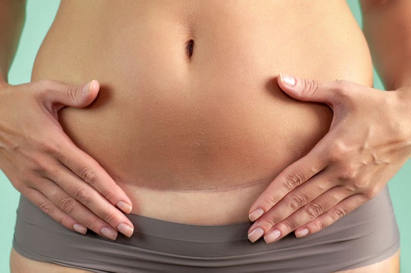 cuidados cicatriz da abdominoplastia