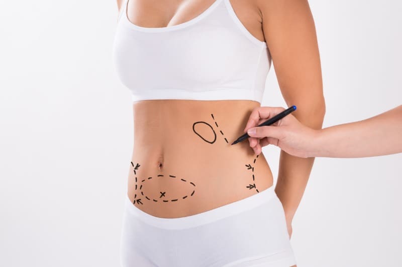 momento certo para fazer abdominoplastia