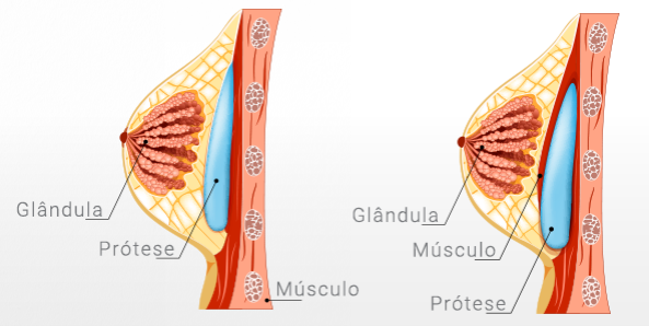 prótese mamária