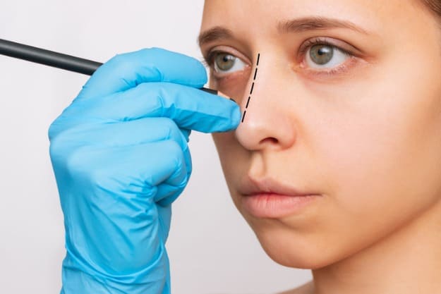 indicações para rinoplastia