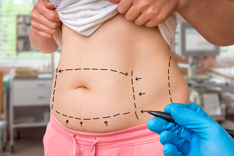 o que é a abdominoplastia