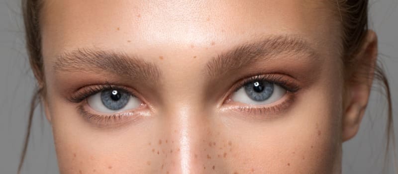 Paciente mostrando o resultados antes e depois da blefaroplastia