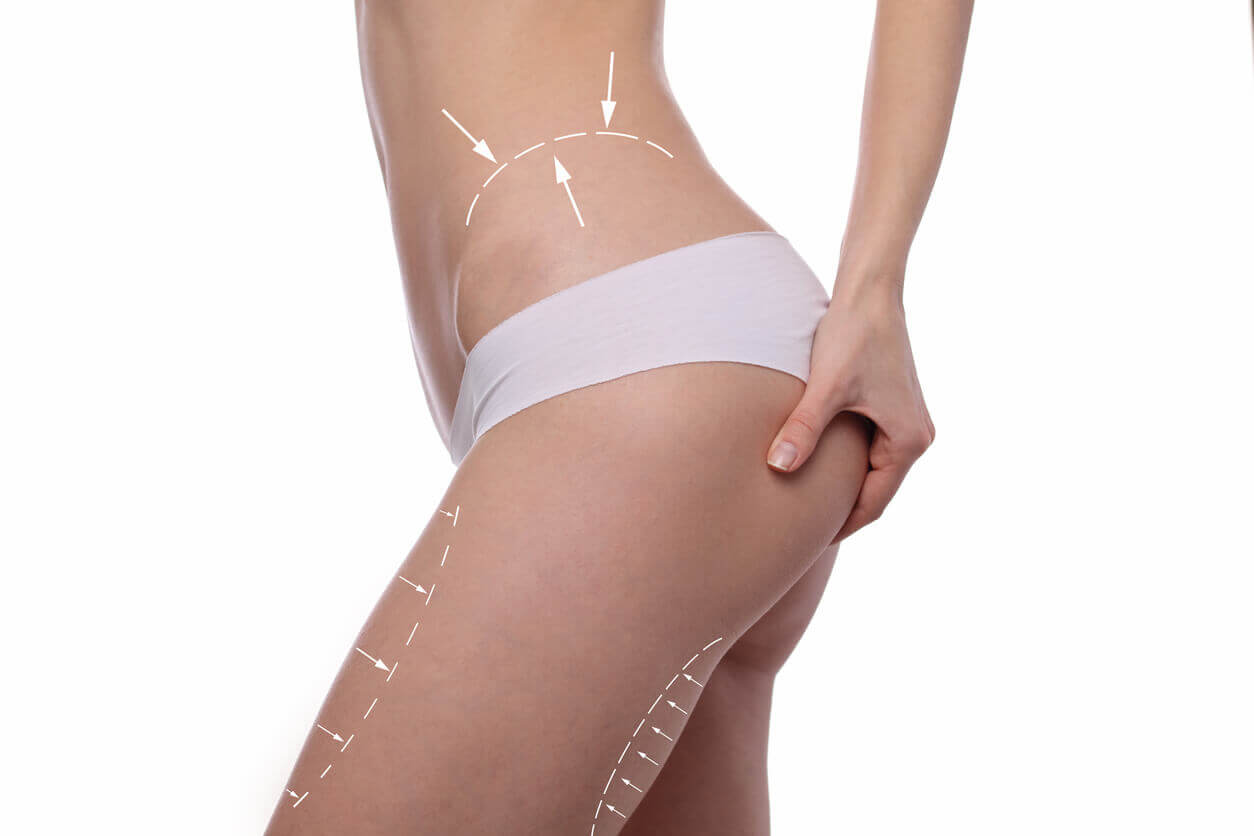 Corpo feminino em roupa íntima branca, com marcações de setas indicando áreas comumente tratadas por cirurgias plásticas, como abdômen, cintura, glúteos e coxas, representando o contorno corporal buscado em procedimentos estéticos.