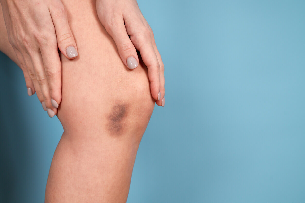 close-up de perna com hematoma escuro, representando possível sintoma do lipedema