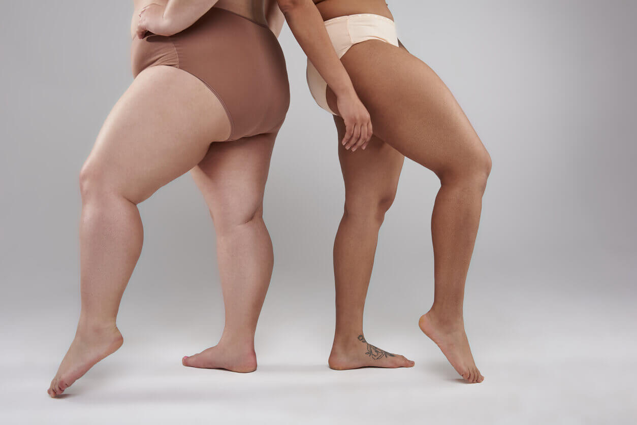 Pernas femininas com diferenças de volume e contorno ilustrando os estágios do lipedema e as variações físicas em cada fase da condição.