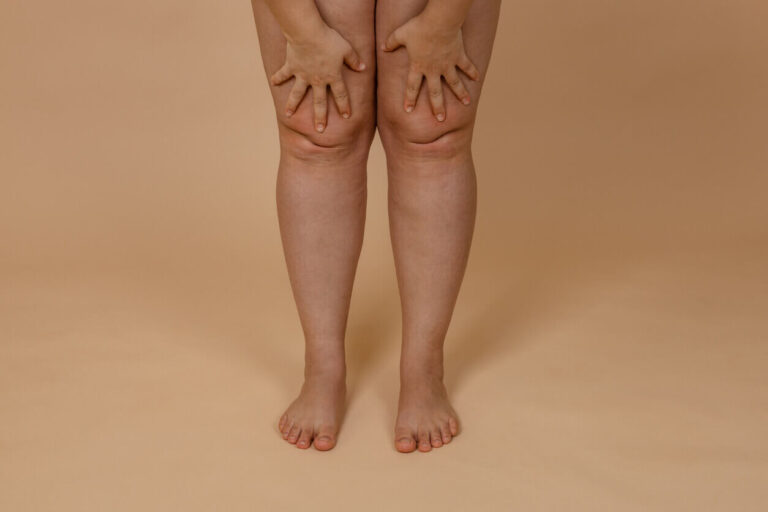 Pernas femininas com acúmulo desproporcional de gordura característico do lipedema, representando os impactos do lipedema e autoestima na imagem corporal.