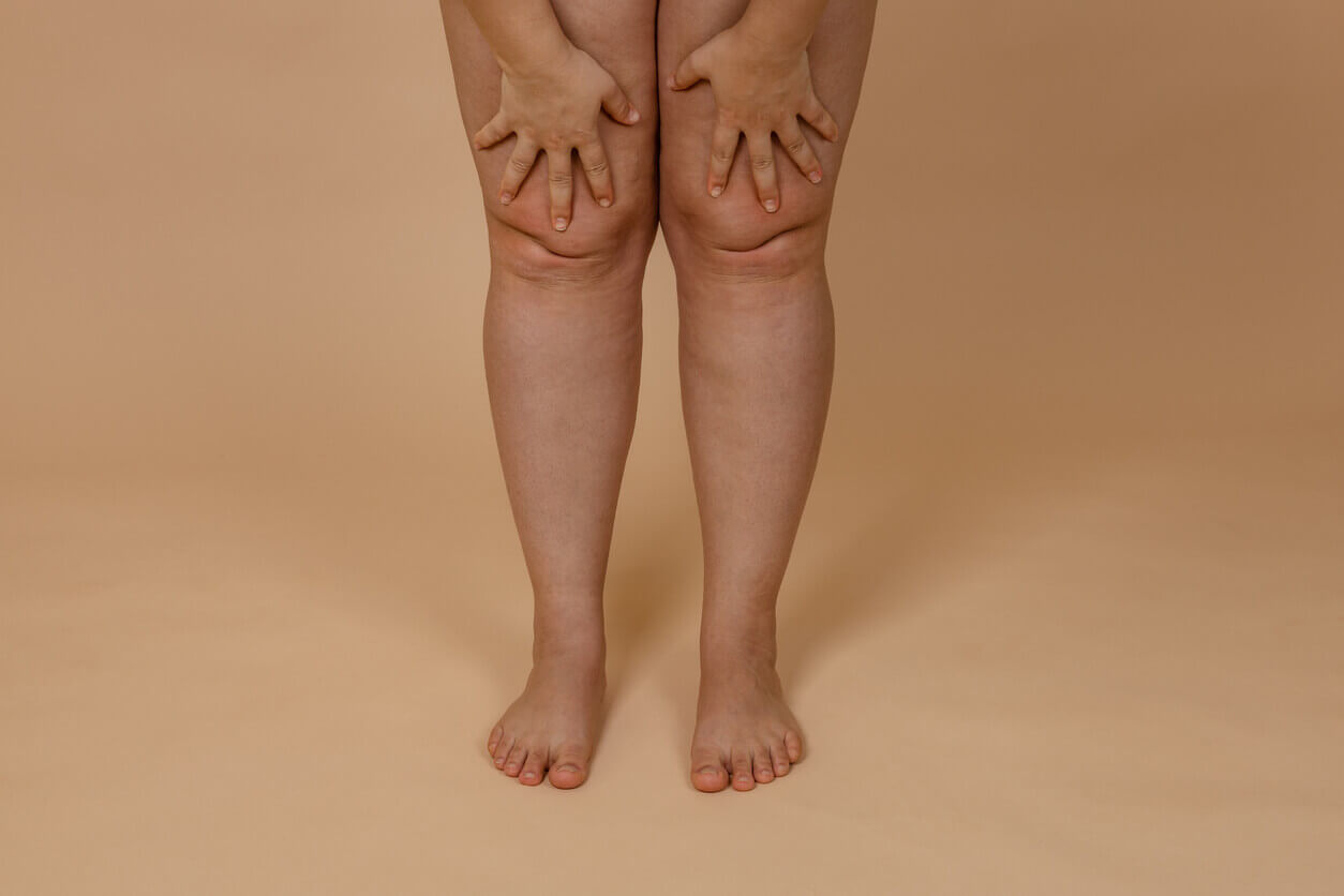 Pernas femininas com acúmulo desproporcional de gordura característico do lipedema, representando os impactos do lipedema e autoestima na imagem corporal.