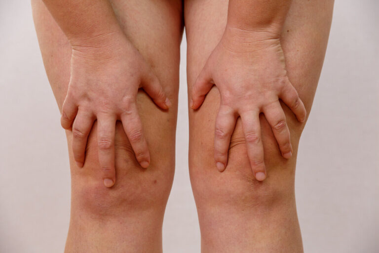 Inchaço característico de lipedema no joelho com aumento de volume e acúmulo de gordura ao redor da articulação