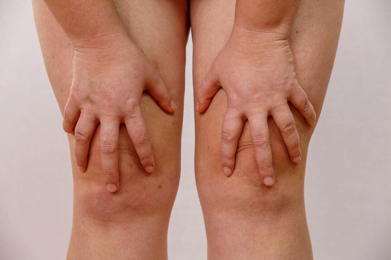 Inchaço característico de lipedema no joelho com aumento de volume e acúmulo de gordura ao redor da articulação