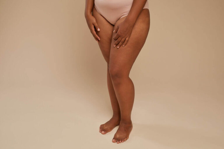 Mulher com as mãos nas coxas, representando os próximos passos após o diagnostico de lipedema.