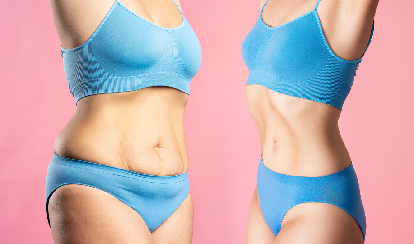 Mulheres antes e depois do emagrecimento com canetas emagrecedoras, destacando mudanças na região abdominal.