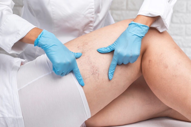 Médica examina pernas com sinais de lipedema e varizes durante avaliação vascular