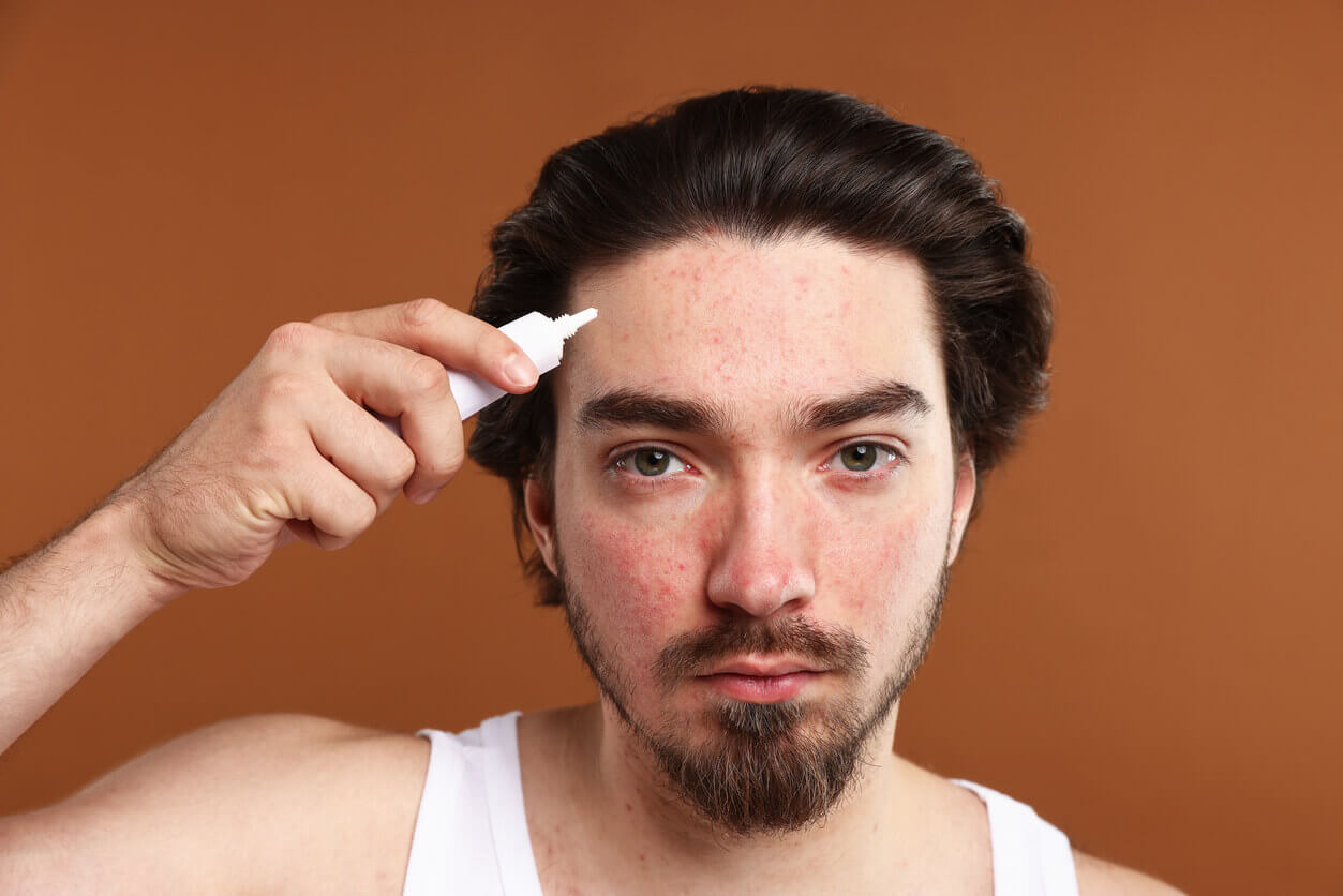 Homem com marcas e cicatriz de acne no rosto aplicando produto na pele, ilustrando conteúdo sobre procedimentos para melhorar a aparência das cicatrizes.