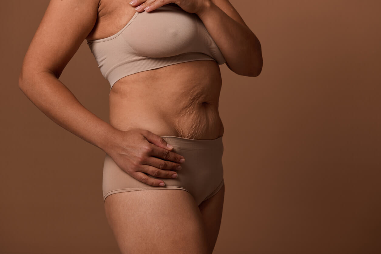 Mulher com flacidez após emagrecimento na região abdominal, mostrando excesso de pele após a perda de peso.