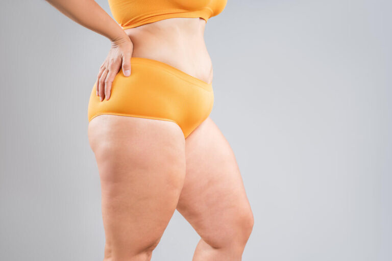 Mulher usando roupa íntima laranja, com destaque para o acúmulo de gordura na região das coxas e acima dos joelhos.