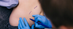 Processo e fases de Cicatrização da Abdominoplastia