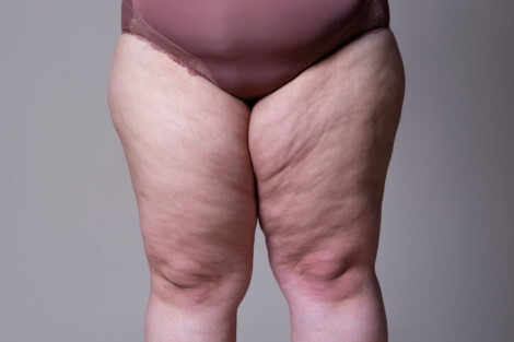 Conheça o Lipedema