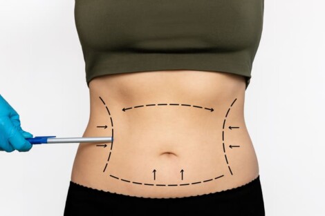 abdominoplastia com lipoaspiração benefícios