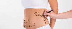 Mulher em avaliação pré-cirúrgica com marcações no abdômen, ilustrando os preparativos para a abdominoplastia pós bariátrica