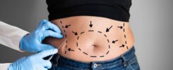 abdominoplastia pós-bariátrica