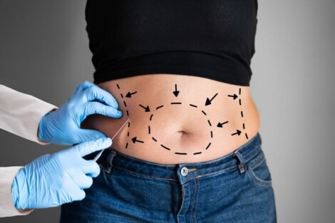 abdominoplastia pós-bariátrica