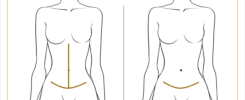 Diferença entre abdominoplastia em âncora ou convencional