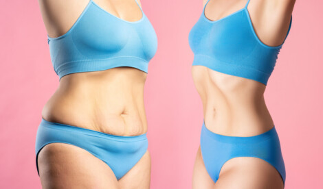 Mulheres antes e depois do emagrecimento com canetas emagrecedoras, destacando mudanças na região abdominal.