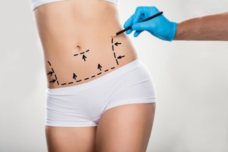 cicatrização abdominoplastia