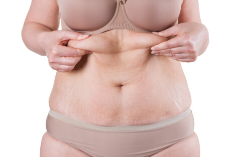 Mulher segurando pele abdominal flácida, representando indicação de cirurgia para excesso de pele em áreas do corpo.