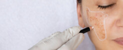 Tratamento estético indicado por profissional para paciente com melasma no rosto, mostrando como tratar melasma de forma direcionada