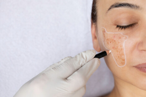 Tratamento estético indicado por profissional para paciente com melasma no rosto, mostrando como tratar melasma de forma direcionada