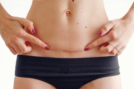 mulher com incisao da abdominoplastia