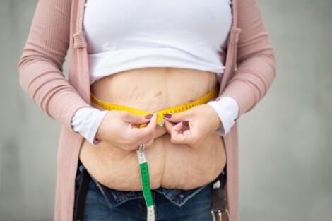 conheça as opções de cirurgias plásticas para flacidez após bariátrica