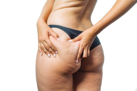 Mulher apertando a pele do bumbum para evidenciar sinais de flacidez nos glúteos.