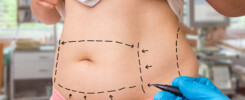 o que é a abdominoplastia