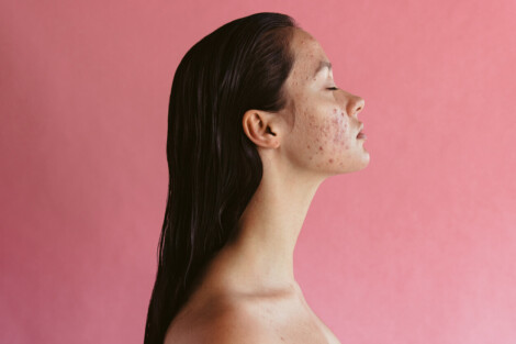 Mulher de perfil com pele com acne, representando cuidados e tratamentos para diferentes fases da condição.